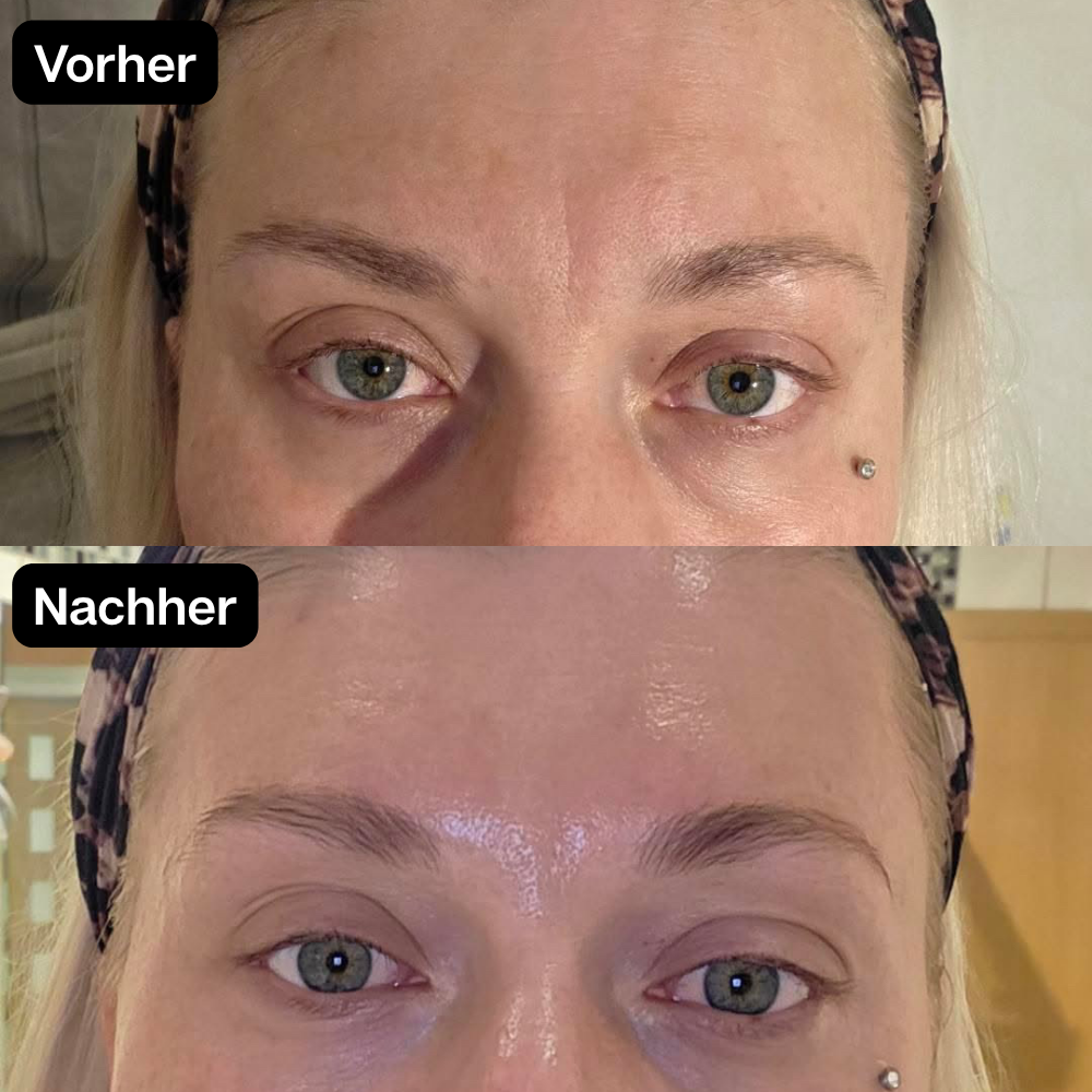 Vorher Nachher Stirnfalten 305 Care